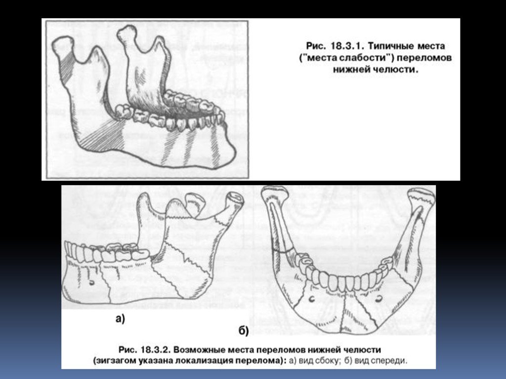 Перелом нижний. Неогнестрельные переломы нижней челюсти диагностика. Неогнестрельные переломы верхней челюсти клиника. Анатомическая классификация переломов нижней челюсти.. Переломы нижней челюсти классификация.