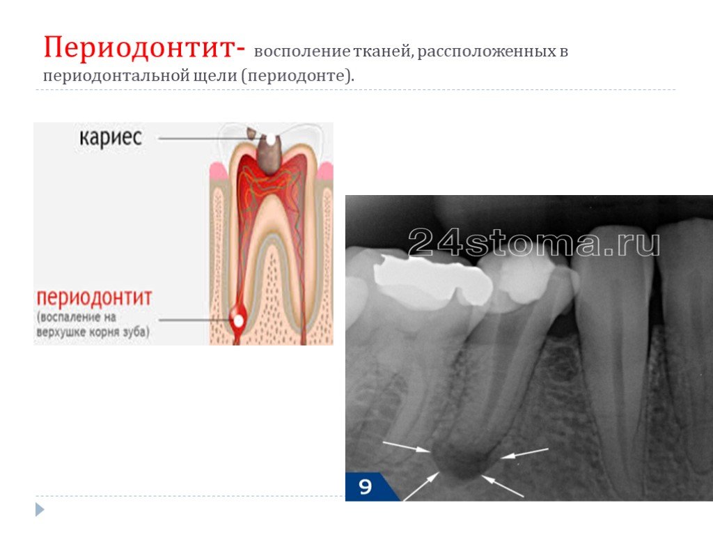 Периодонтит это. Расширение периодонтальной щели периодонтит. Периодонтальная щель зуба. Строение зуба периодонтит. Расширение периодонтальной щели зуба.