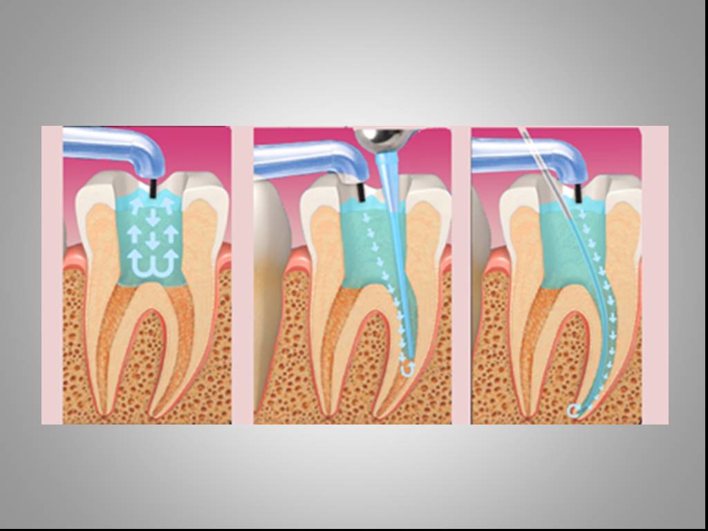 Чем промывают каналы. Гидродинамическая ирригация корневых каналов. Ирригация корневых каналов в эндодонтии. Медикаментозная обработка корневых каналов ирригация. Ирригация ультразвуковая корневых.
