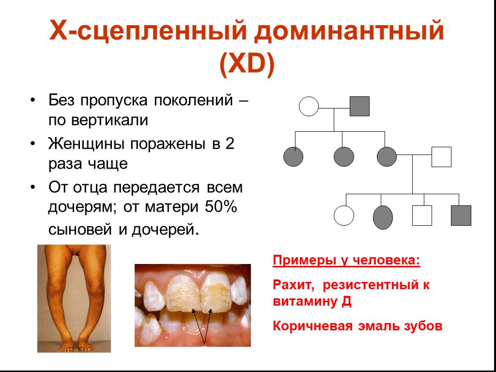 Доминантный сцепленный с х хромосомой заболевания. Сцепленный с х хромосомой доминантный Тип наследования. Х сцепленный доминантный Тип наследования примеры. Доминантный признак сцепленный с х хромосомой. Болезни с х сцепленным доминантным типом наследования.