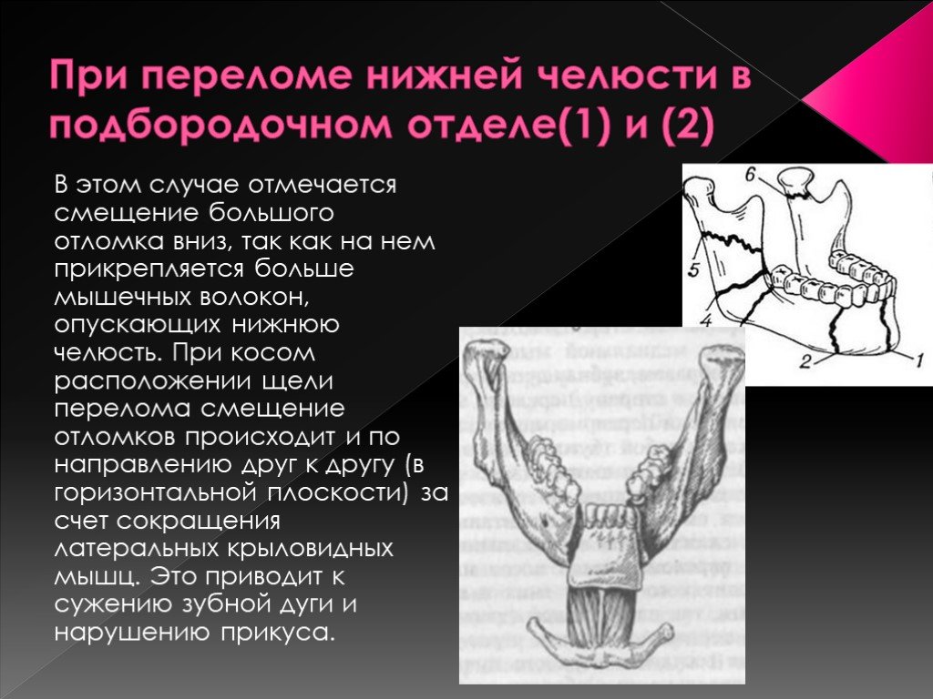 Перелом нижней. Перелом нижней челюсти в ментальном отделе. Перелом нижней челюсти в подбородочном отделе. Смещение отломков при переломе нижней челюсти. Неогнестрельные переломы нижней челюсти презентация.