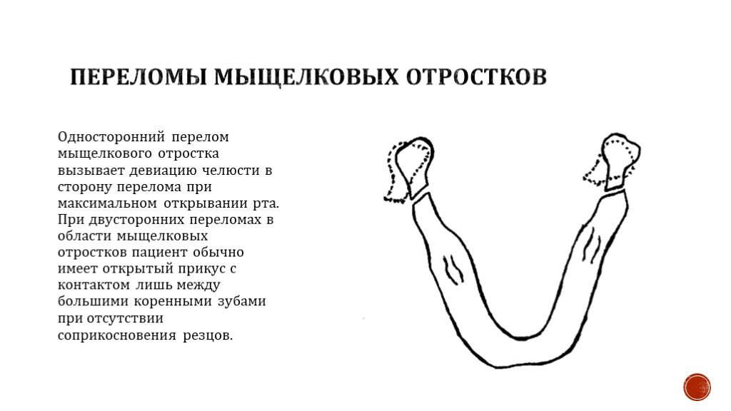 Перелом мыщелкового отростка нижней челюсти. Перелом мыщелкового отростка нижней челюсти клинические проявления. Классификация переломов мыщелкового отростка нижней челюсти. Перелом мыщелкового отростка нижней челюсти симптомы. Односторонний перелом мыщелкового отростка симптом.