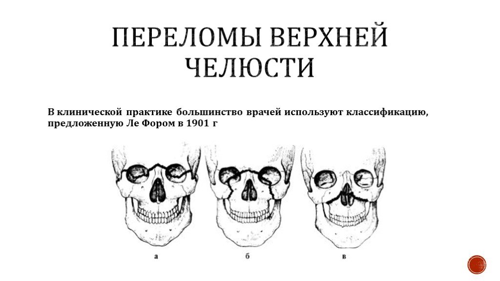 Переломы костей верхней челюсти. Лефор переломы верхней челюсти. Классификация переломов верхней челюсти по Лефору. Лефор классификация переломов верхней челюсти. Перелом верхней челюсти Лефор 2.