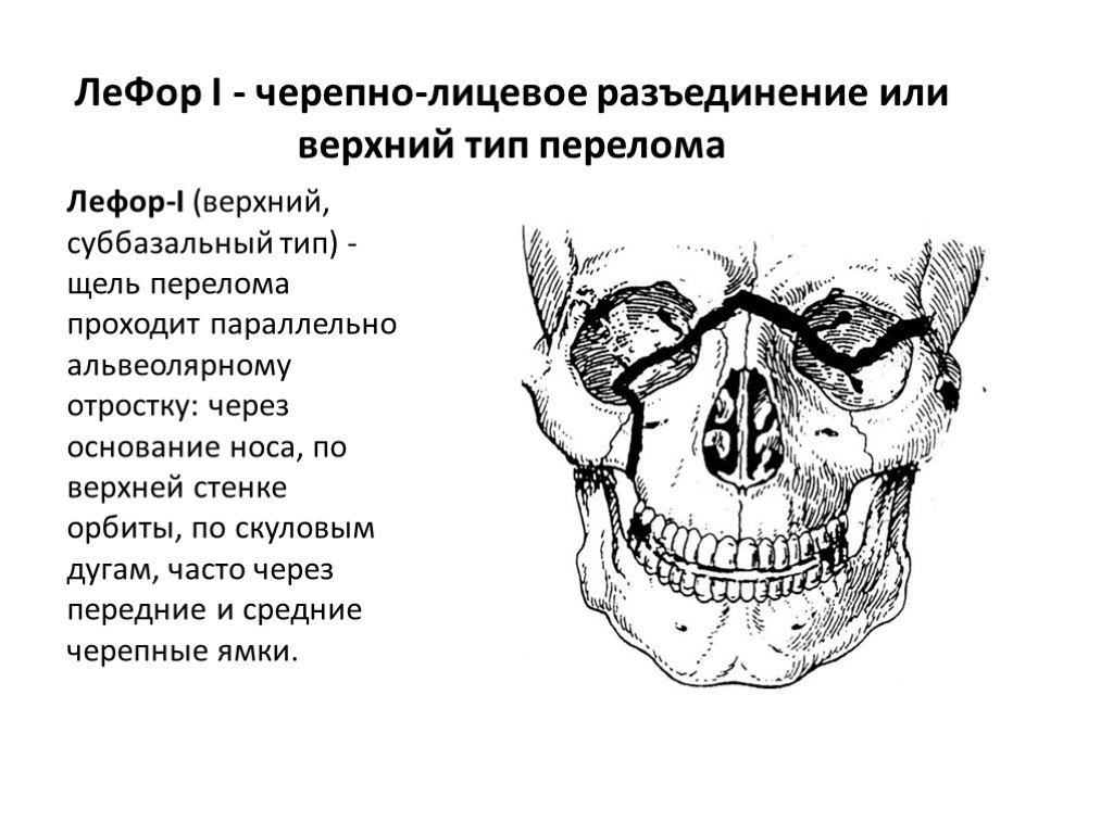 Верхний тип. Перелом верхней челюсти по Ле фор 1. Переломы верхней челюсти классификация Ле фор. Перелом верхней челюсти Лефор III. Клиника перелом верхней челюсти Лефор.