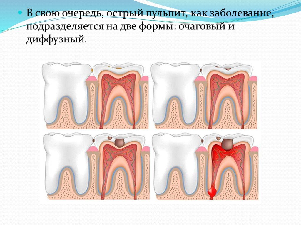 Острый диффузный пульпит. Острый очаговый и диффузный пульпит. Острый очаговый пульпит. Острый диффузный пульпит патанатомия.