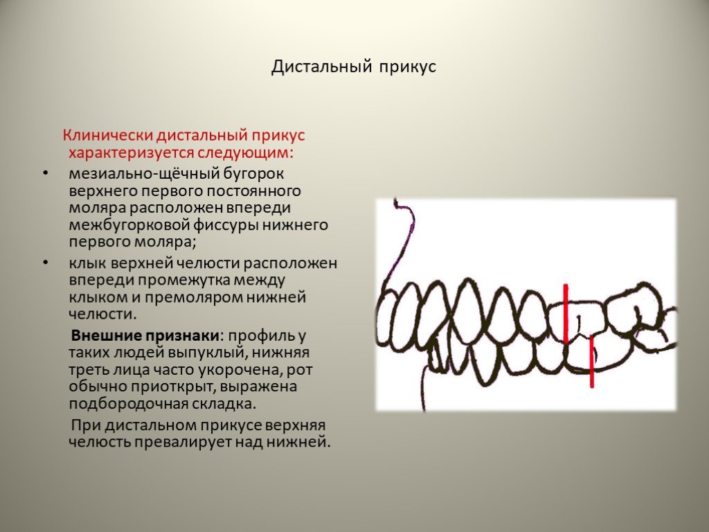 Дистальная окклюзия. Этиология дистального прикуса. Патогенез мезиальной окклюзии. Дистальный и мезиальный прикус. Этиология мезиальной окклюзии.