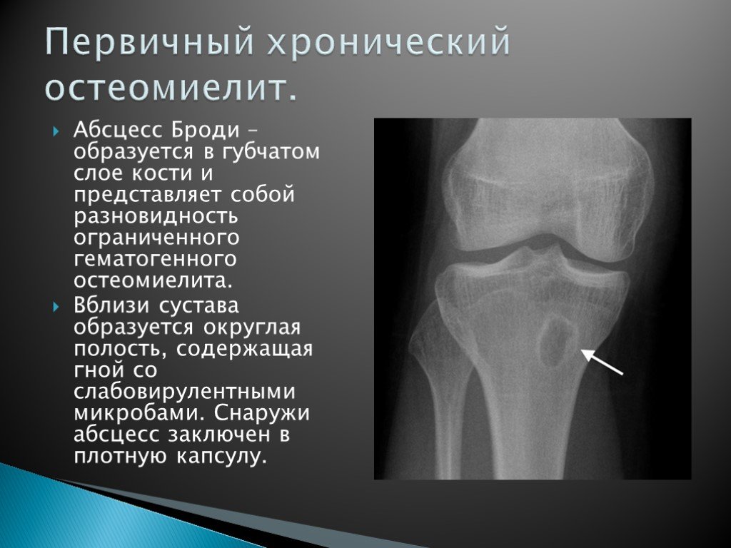 Эпифизарный остеомиелит у детей презентация