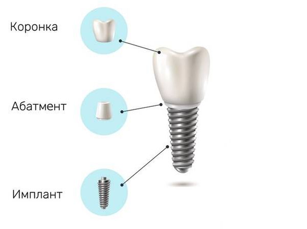 Схема импланта зуба