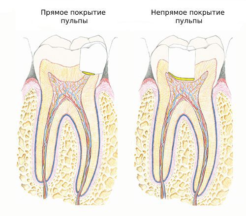 Апексогенез и апексификация. Непрямое покрытие пульпы зуба осуществляется. Метод прямого и непрямого покрытия пульпы. Методика прямого покрытия пульпы зуба. Биологический метод прямое покрытие пульпы.