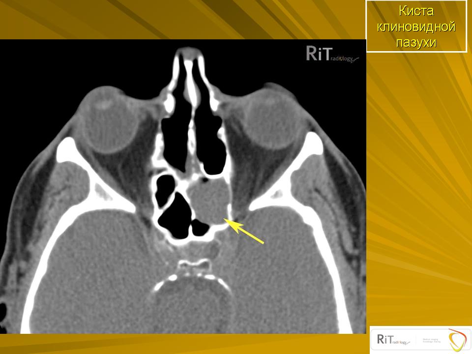 Клиновидная пазуха. Гранулематоз Вегенера пазухи кт. Киста клиновидной пазухи. Клиновидная пазуха носа на кт.