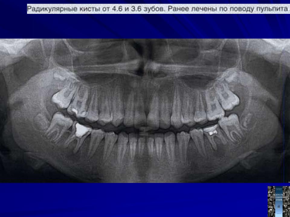 Лечение кисты зуба. Радикулярная киста челюсти рентген. Нагноившаяся радикулярная киста. Радикулярная киста с нагноением. Фолликулярная киста альвеолярного отростка кт.