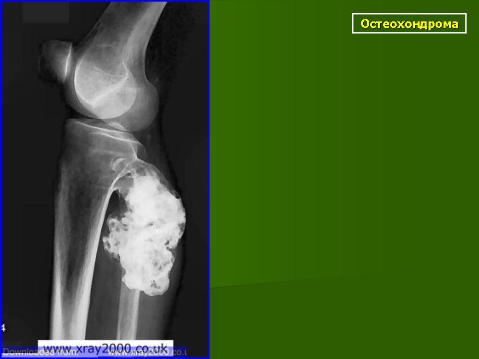 Остеохондрома бедренной. Экзостоз плечевой кости. Экзостоз бедренной кости. Костно-хрящевой экзостоз (остеохондрома).. Экзостоз большеберцовой кости на кт.