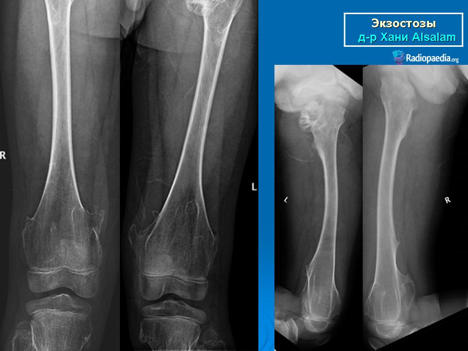 Экзостоз мкб. Костный экзостоз бедренной кости. Экзостоз малой берцовой кости. Экзостоз большеберцовой кости рентген.