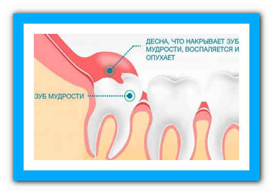Сколько может болеть зуб после. Прорезывание зуба мудрости. Прорезающийся зуб мудрости. Зуб мудрости осложнения.