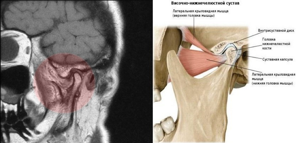 Височно нижнечелюстной артрит. Кт височно-нижнечелюстного сустава. Магнитно-резонансная томография височно-нижнечелюстного сустава. Магнитно-резонансная томография артрит ВНЧС. Суставной диск височно-нижнечелюстного сустава мрт.