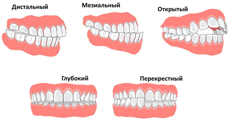 Правильный прикус у человека схема как определить