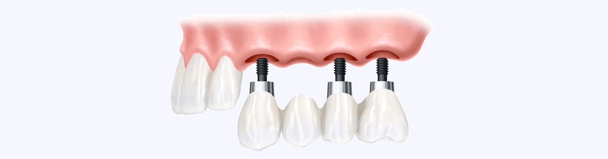 Мост на имплантах на 4 зуба фото