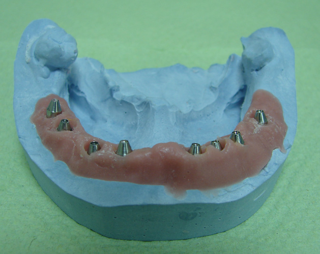 Рабочая модель. Протезирование на имплантатах Astra Tech. Модели гипсовые имплантация. Разборная модель на имплантах.