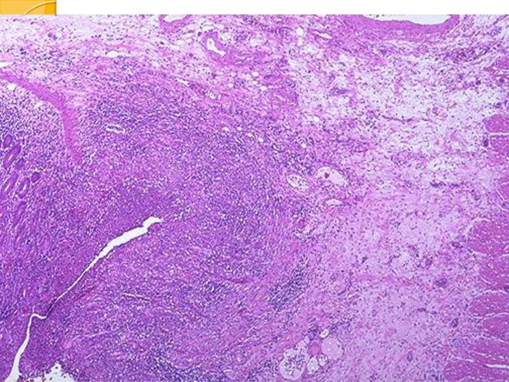 Гистологическая картина. Болезнь крона гистология. Болезнь крона микропрепарат. Гранулема крона гистология. Болезнь крона патанатомия.