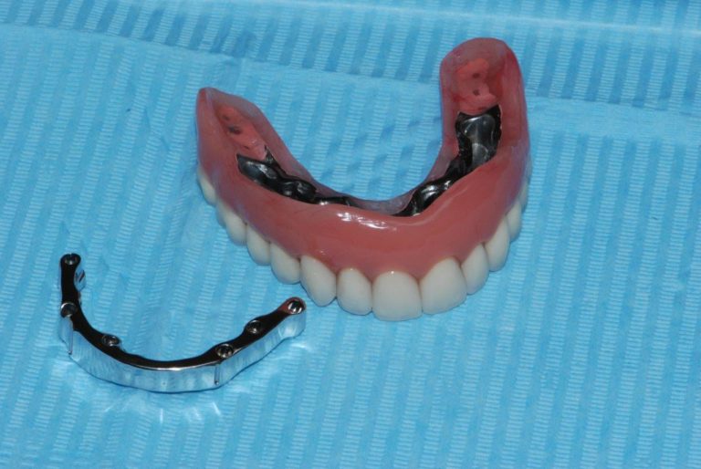Протез на челюсть без зубов. Съемный протез (6-14 зубов) термо Джет. Пластинчатый микропротез. Съёмный зубной протез на крючках.