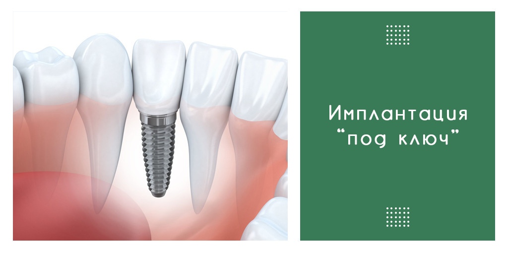 Имплант под ключ. Ключ для имплантации. Горячий ключ имплантация зубов. Импланты лендинг. Классический имплант под ключ фото.