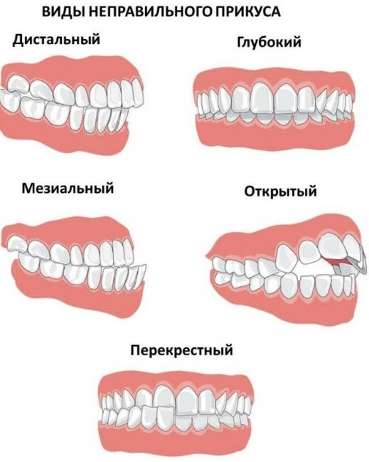 Правильный прикус у человека схема как определить фото