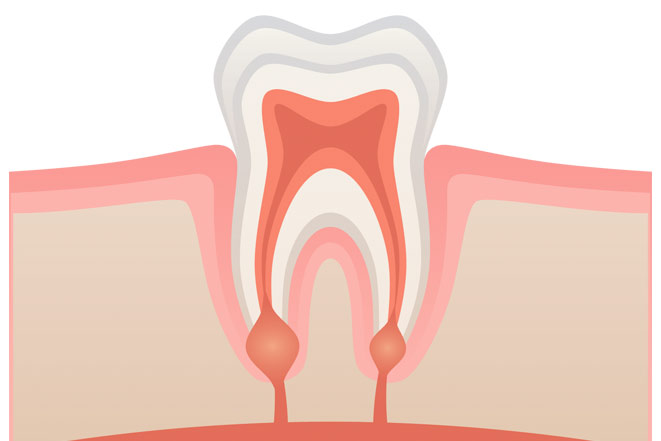 Зубные воспаление. Воспаление у основания корней зуба. Воспаление за корнем зуба причины. Воспаление зубного корня симптомы.