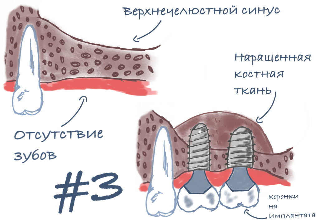 Имплант с наращиванием костной ткани. Наращивание костной ткани для имплантации. Наращивание кости для имплантов.