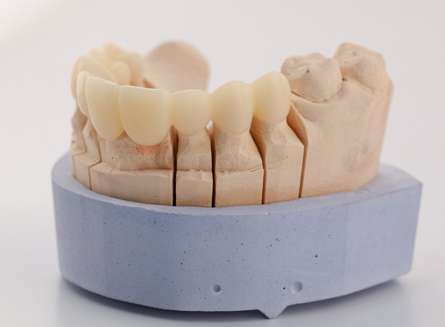 Рабочая модель. Несъёмные мостовидные шинирующие протезы. Экстракоронковые несъемные протезы. Моделировка каркаса Emax. Несъемные зубные протезы.