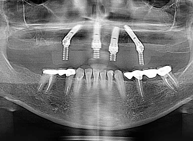 Мосты на 4 имплантах