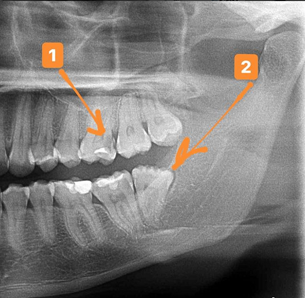 Снимок зубов видное