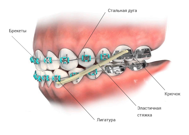 Схемы ношения эластиков при брекетах
