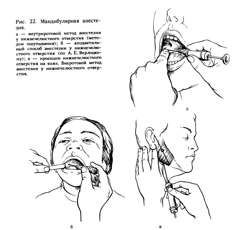 Мандибулярная анестезия в стоматологии схема