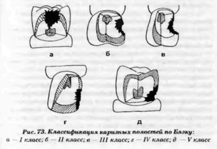 V класс по блэку. Классификация кариозных полостей по Блэку. Классификация кариозных полостей по Блэку в стоматологии. Классы кариозных полостей по Блэку. Стоматология по Блэку класс 1.