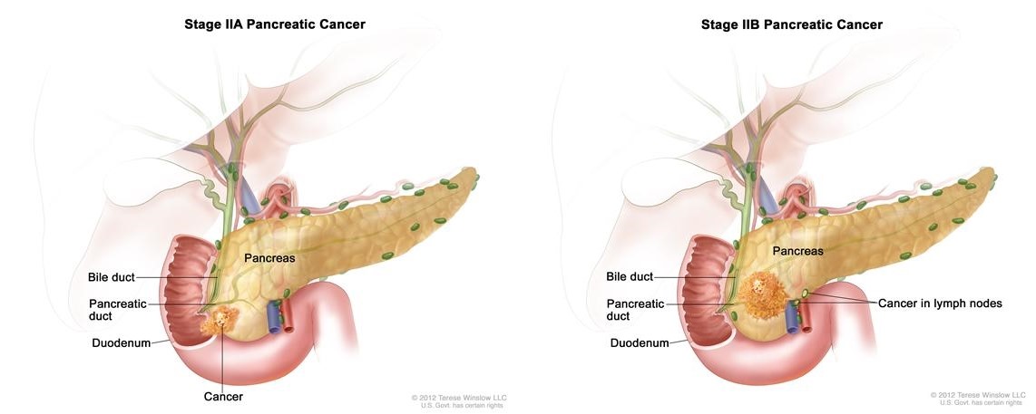 Рак поджелудочной 4 стадия сколько живут. Опухоль поджелудочной железы. Опухоли поджелудочной железы классификация. Онкология поджелудочной железы. Метастазы поджелудочной железы.