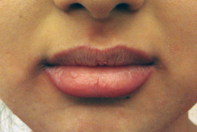 Верхний край губы. Пигментация контура губ. Пигментация по контуру губ.