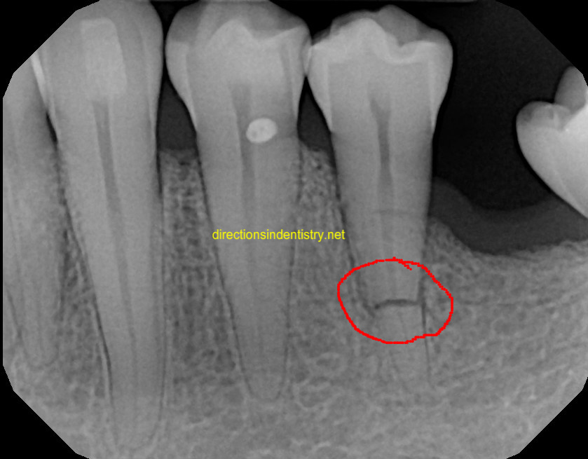 Рассосался корень зуба. Поперечный перелом зуба рентген. Поперечный перелом корня зуба рентген. Поперечный перелом корня зуба снимок. Перелом верхушки корня 3.8 зуба рентген.