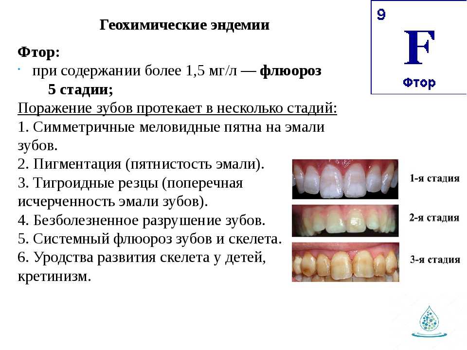 Биогеохимические эндемические заболевания. Эндемический флюороз зубов. Флюороз временных зубов. Меловидно-крапчатая форма флюороза зубов.. Эндемические заболевания флюороз.