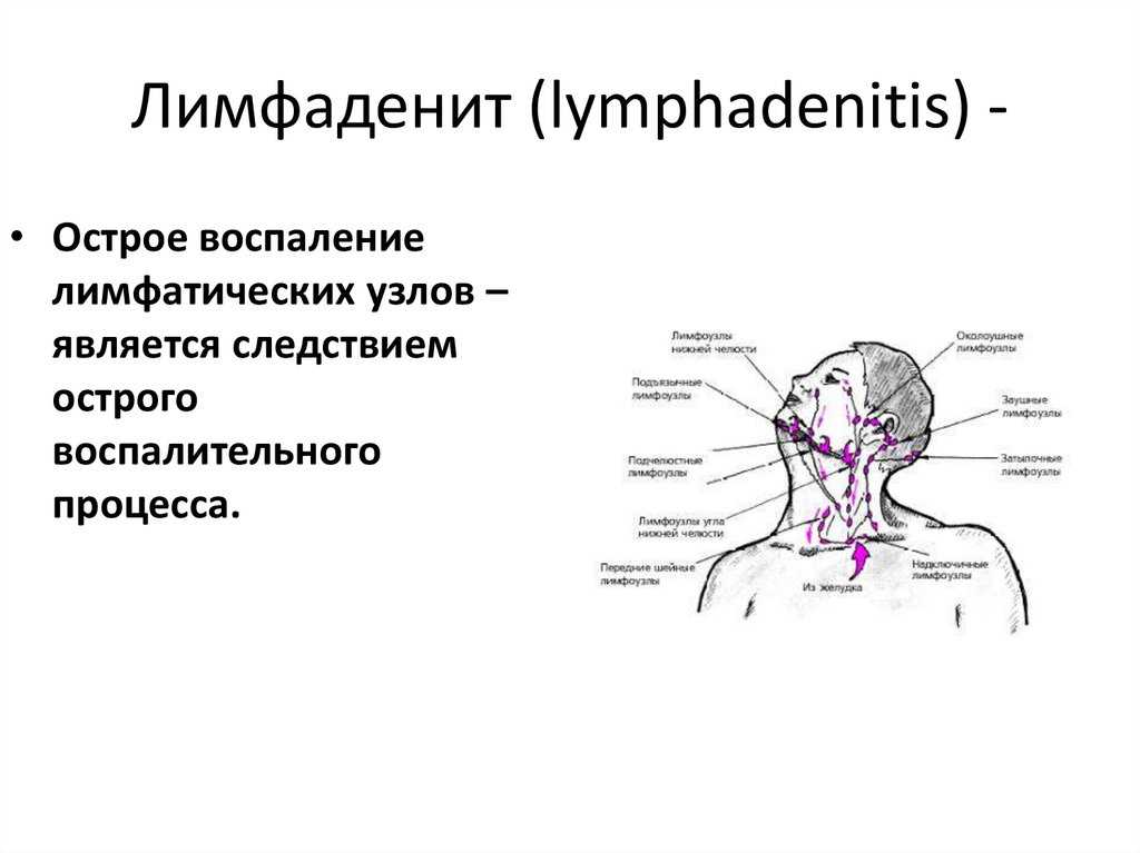 Лимфоузлы под челюстью схема как лечить воспаление