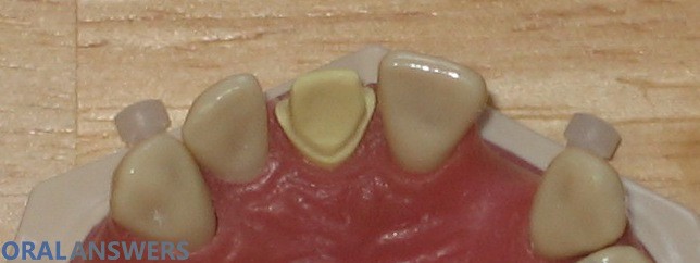 Dental Crown Tooth Prepared Tongue Side View