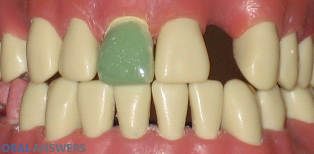 Tooth with a Temporary Crown