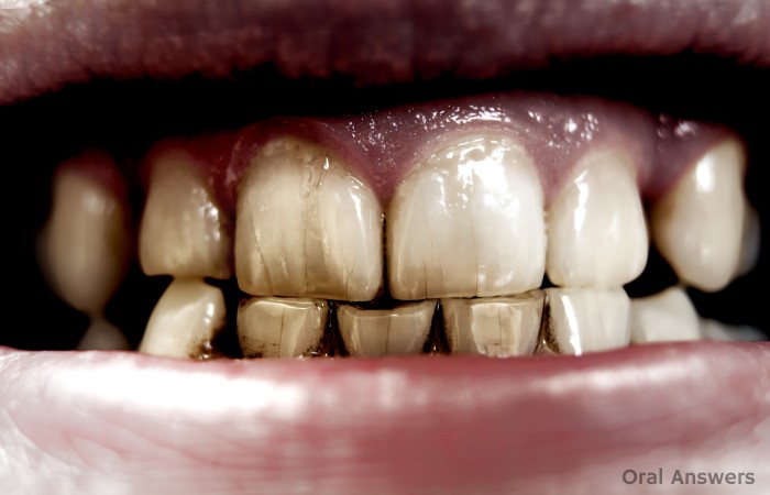 Craze Lines Appearing on Stained Teeth