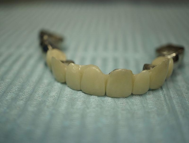 Зубы металлокерамика мосты