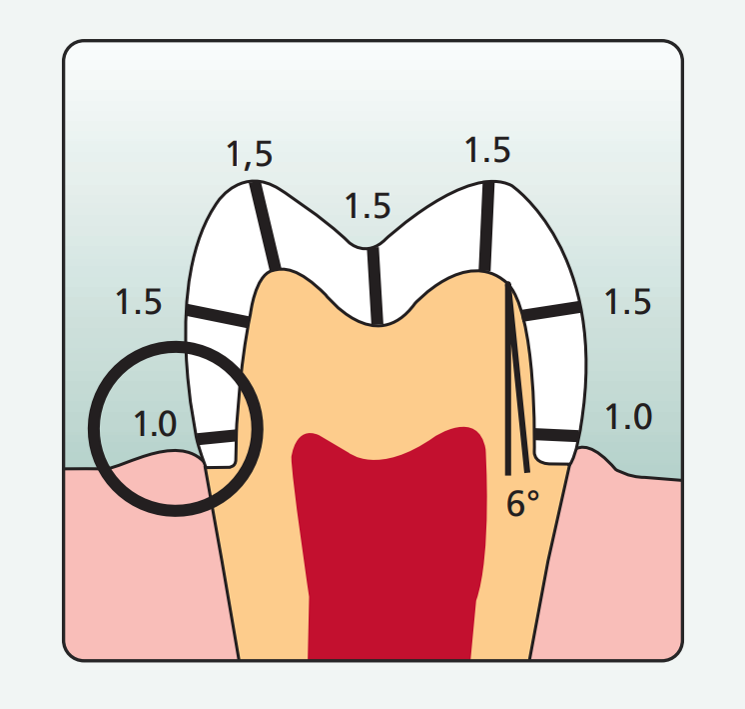 Латеральные зубы. Толщина препарирования под металлокерамическую коронку. Цельнокерамическая коронка препарирование. Препарирование под коронку из Emax. Эргономика препарирования зубов.