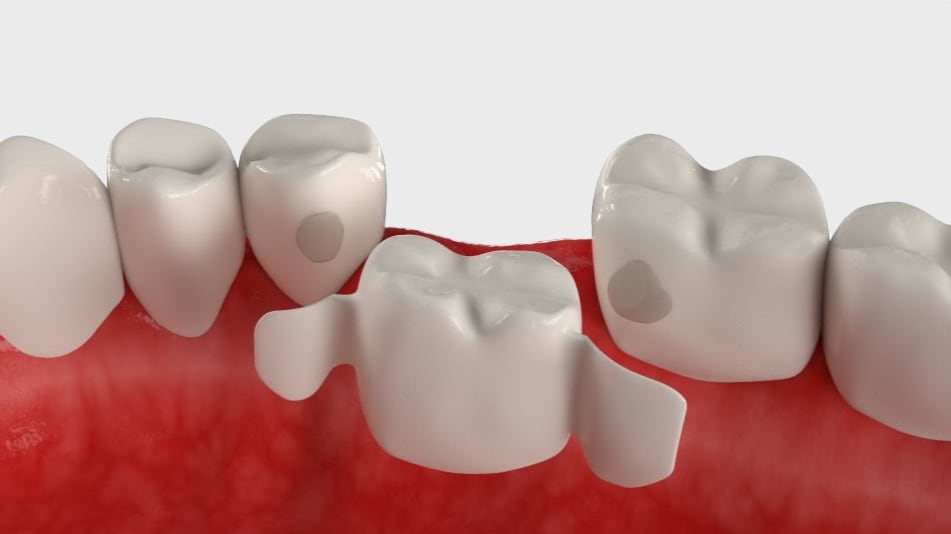 Что такое мост в стоматологии фото