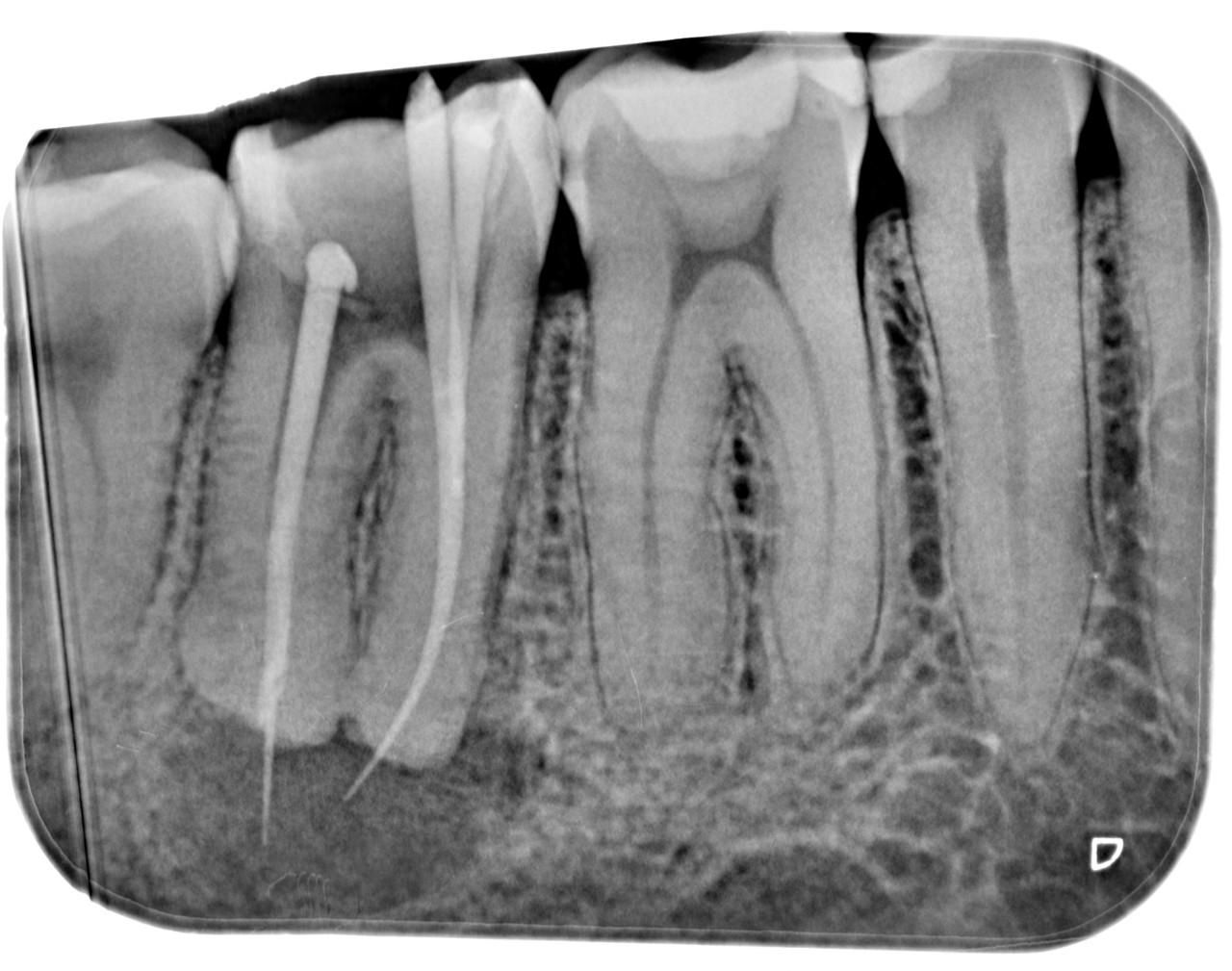 Рассосался корень зуба. Запломбированные корневые каналы. Пломбировка каналов зуба рентген. Воспаление корня зуба на рентгене. Периапикальный абсцесс.