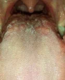 Увеличенные желобовидные сосочки или вкусовые рецепторы – самая частая причина бугорков на корне языка