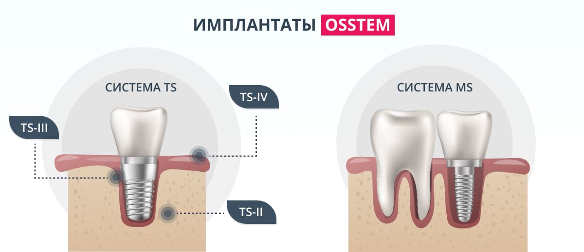 Ставить имплант зуба больно отзывы