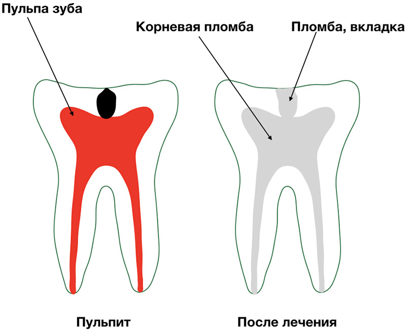 Удаленный нерв зуба