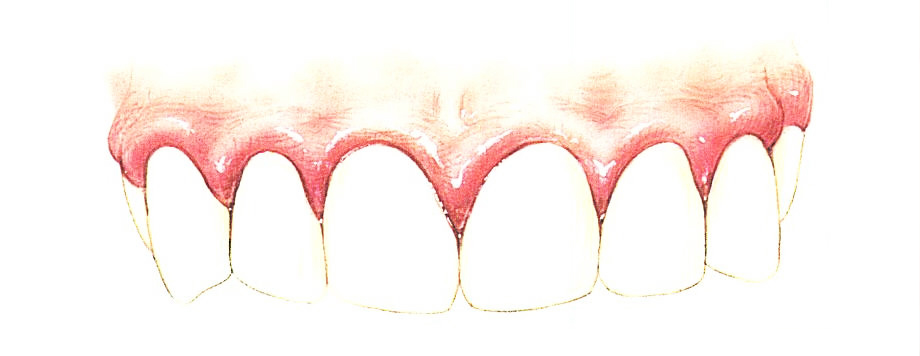 Болезни десен фото и описание